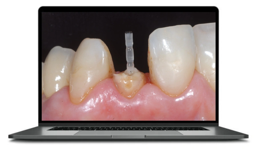 Gdy endodonta przekazuje pałeczkę protetykowi - odbudowa zębów po leczeniu kanałowym
